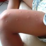 chikungunya2